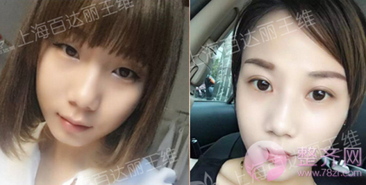 上海百达丽王维自体脂肪填充面部多少钱?