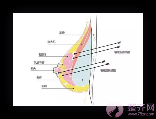 上海华美整形邓守成隆胸怎么样?有没有案例?