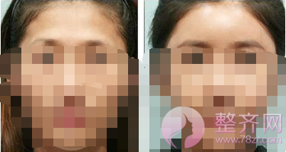 北京东方瑞丽自体脂肪丰额头怎么样?好不好?