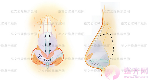 北京米扬丽格巫文云隆鼻失败修复怎么样?有没