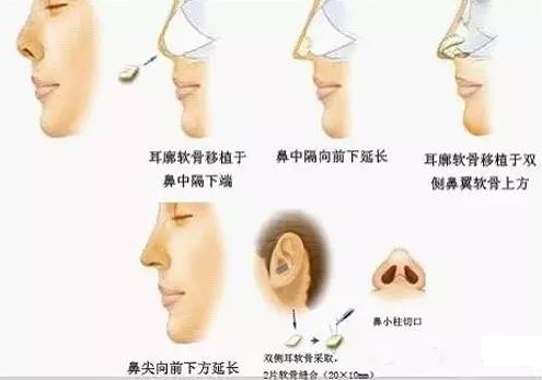 单纯隆鼻能改善朝天鼻吗?