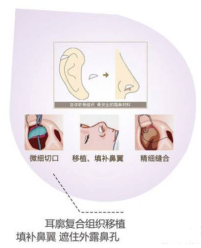 单纯隆鼻能改善朝天鼻吗?
