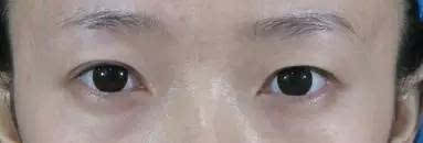 一单一双的眼皮该怎么办?