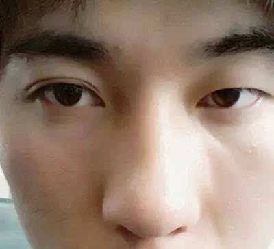一单一双的眼皮该怎么办?