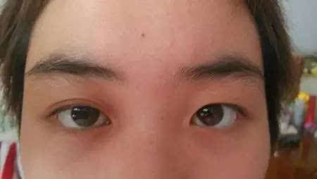 一单一双的眼皮该怎么办?