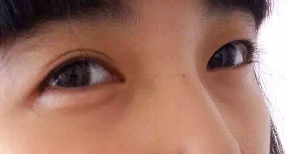 一单一双的眼皮该怎么办?