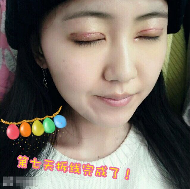 一单一双的双眼皮手术案例对比!