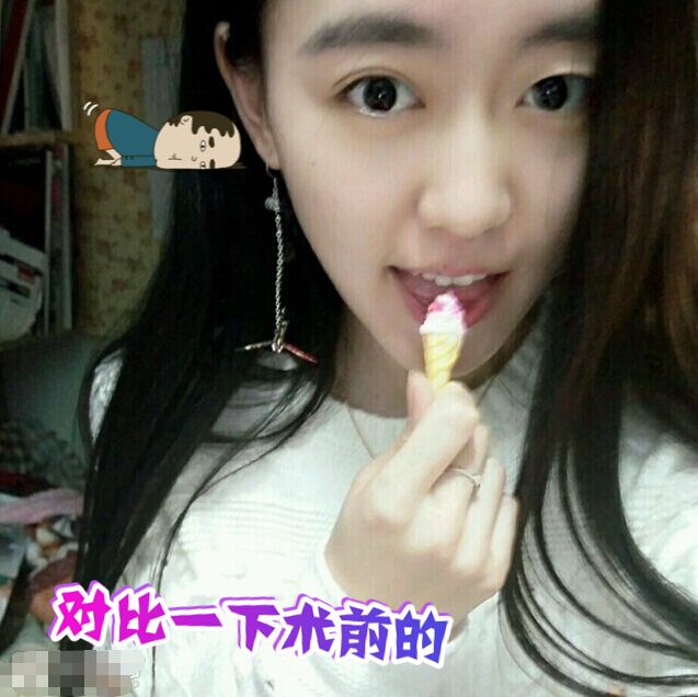 一单一双的双眼皮手术案例对比!
