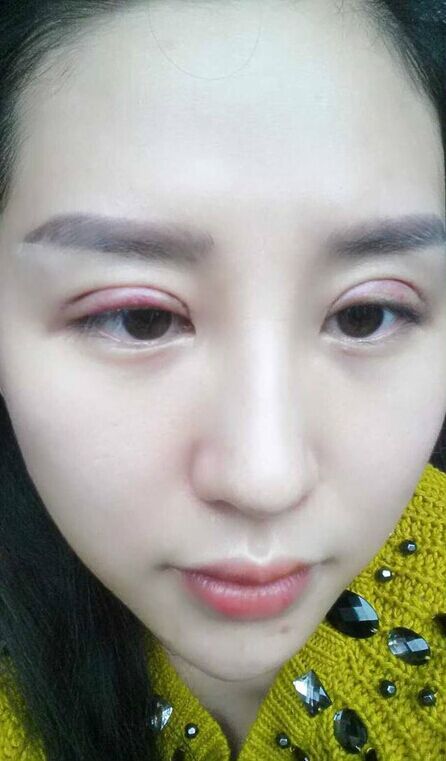 三次双眼皮修复成功案例!
