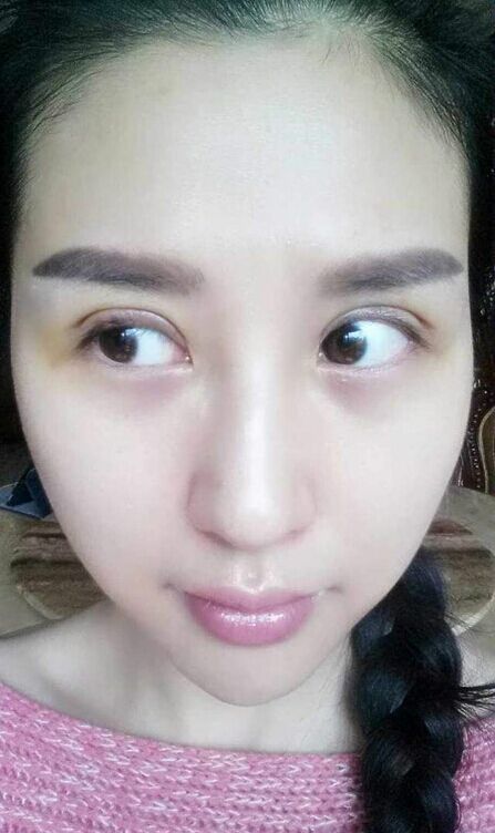 三次双眼皮修复成功案例!