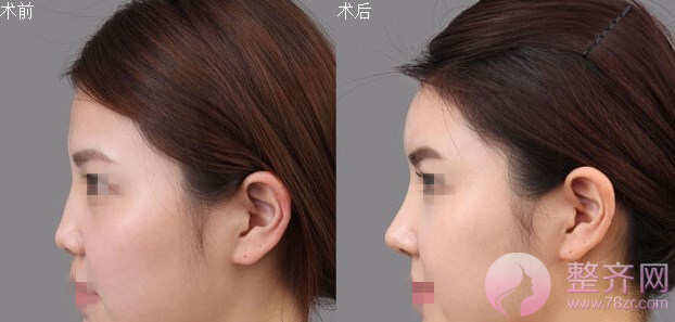 成都西蝉邵文辉隆鼻怎么样?价格贵不贵?
