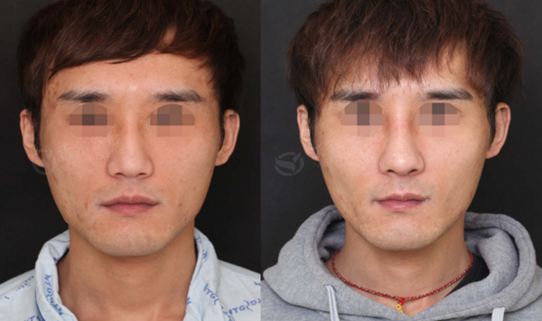 隆鼻前后变化大吗?真的好看吗?