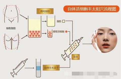 说说自体脂肪和玻尿酸丰太阳穴