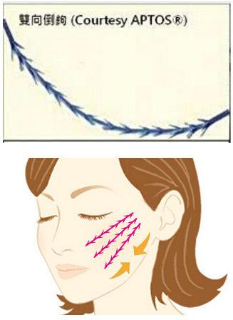 蛋白埋线提升都有什么区别吗?