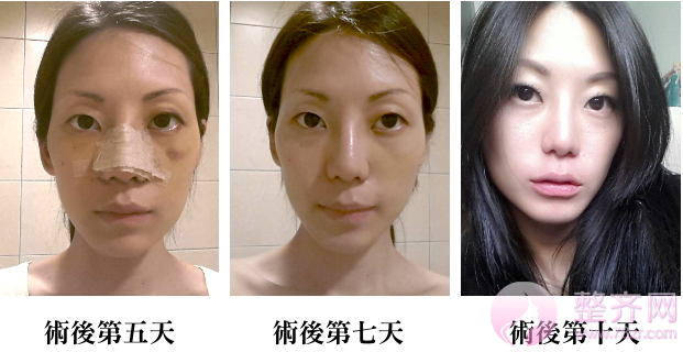 成都蜀尚蓉雅陶俊隆鼻多少钱?有没有案例图?