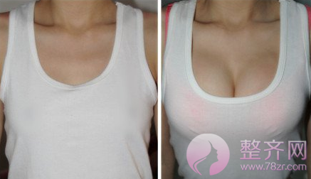 广州曙光孙婧假体隆胸怎么样?多少钱?