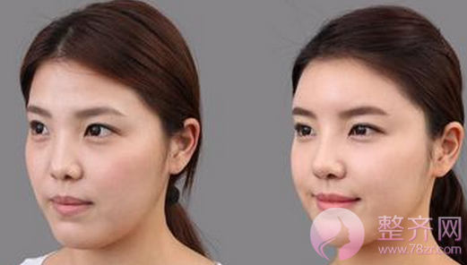 广州美莱罗延平隆鼻怎么样?案例图?
