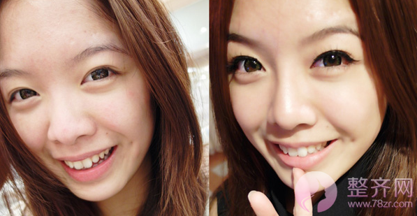 广州美莱李高峰隆鼻怎么样?案例图?