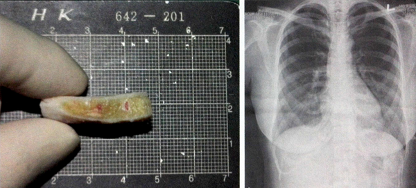 各种自体软骨隆鼻真的好不好?