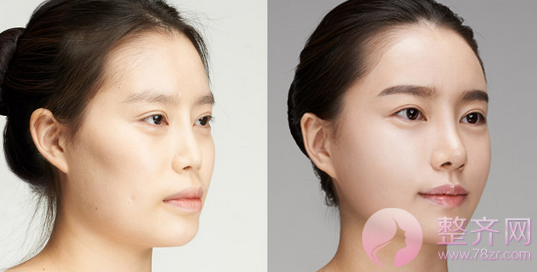 广州华美沈绍勇隆鼻怎么样?案例图?