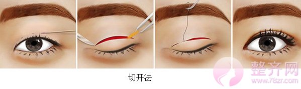 广州华美阮庆玲割双眼皮怎么样?案例图?