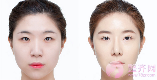广州华美阮庆玲割双眼皮怎么样?案例图?