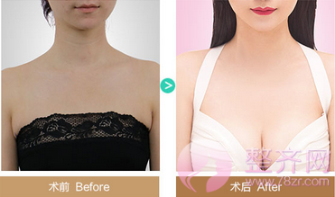 广州紫馨郑宰昊隆胸怎么样?多少钱?