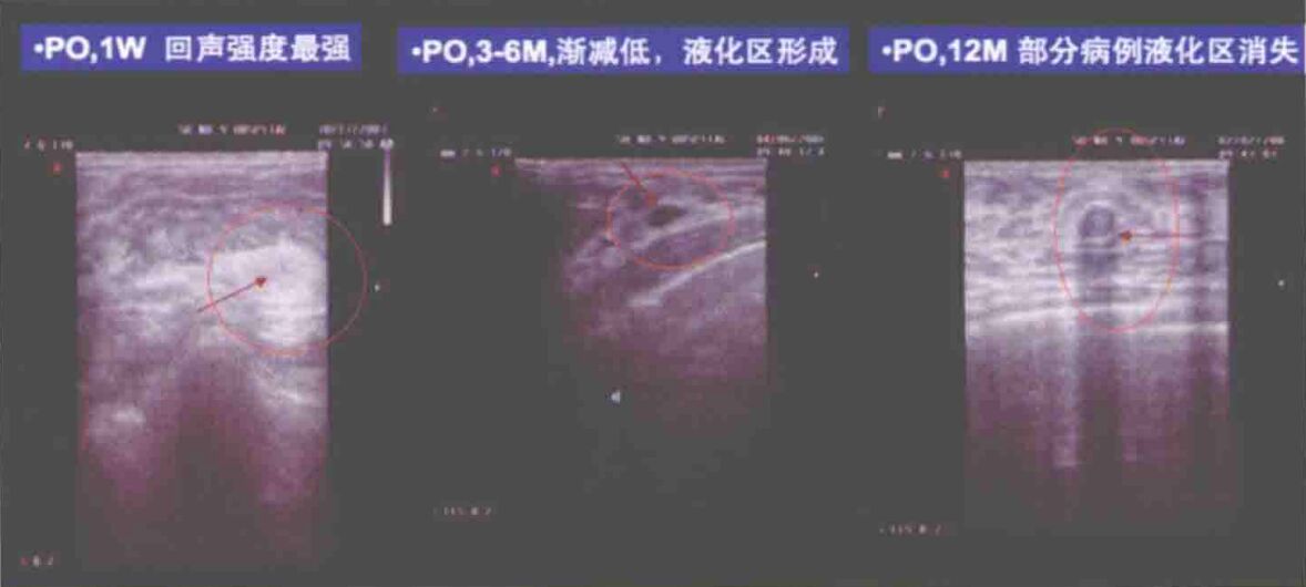 自体脂肪移植隆胸后的影像是如何表现的?