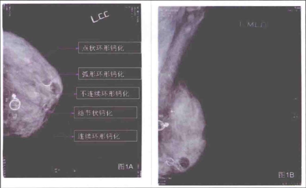 自体脂肪移植隆胸后的影像是如何表现的?