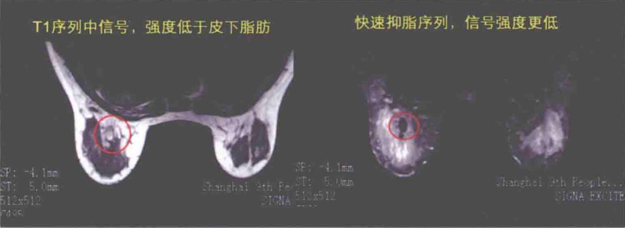 自体脂肪移植隆胸后的影像是如何表现的?