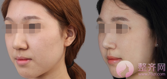 北京王磊隆鼻怎么样?多少钱?