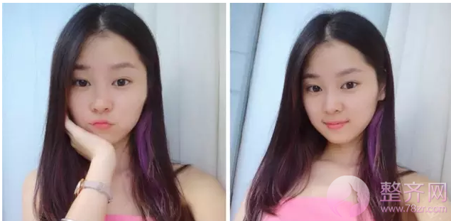 北京伊美尔黄志祥隆鼻怎么样?多少钱?