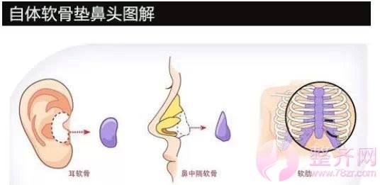 隆鼻有哪几种方法呢?
