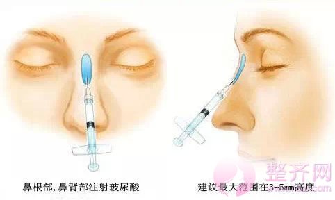 隆鼻有哪几种方法呢?