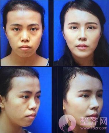 为什么做完隆鼻,还是不好看?