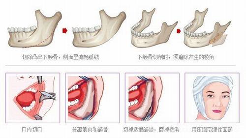 下颌角手术是怎么样的?好不好?