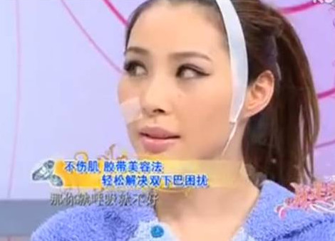 胶带贴一贴,双下巴就没了?整形医生惊呆了