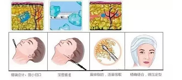 脸大打注射瘦脸就够了?“对阵下药”才有!