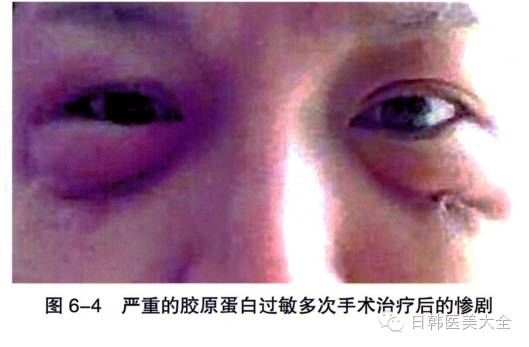 胶原蛋白注射好吗?有并发症、副作用吗?