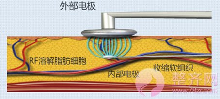 吸脂仪器及手法的问题!