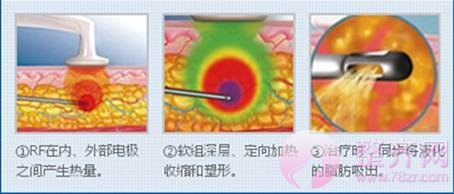 吸脂仪器及手法的问题!