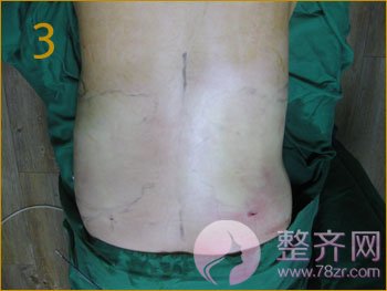 北京丹熙魏洁吸脂怎么样?魏洁面部吸脂案例?