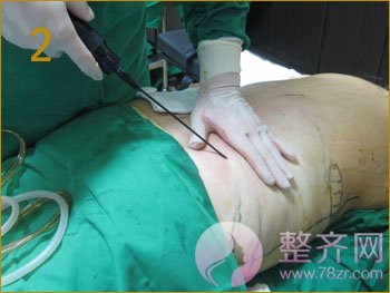 北京丹熙魏洁吸脂怎么样?魏洁面部吸脂案例?