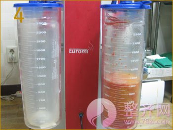 北京丹熙魏洁吸脂怎么样?魏洁面部吸脂案例?