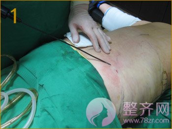 北京丹熙魏洁吸脂怎么样?魏洁面部吸脂案例?
