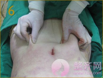 北京丹熙魏洁吸脂怎么样?魏洁面部吸脂案例?