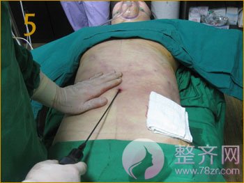 北京丹熙魏洁吸脂怎么样?魏洁面部吸脂案例?