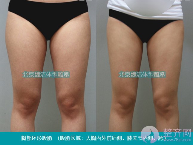 北京丹熙魏洁吸脂怎么样?魏洁面部吸脂案例?
