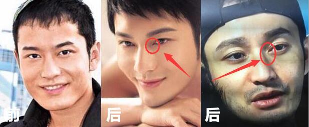 开眼角手术后留下明X疤痕,该怎么办?