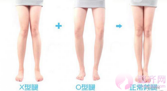北京华意整形李沁奕O型腿矫正怎么样?